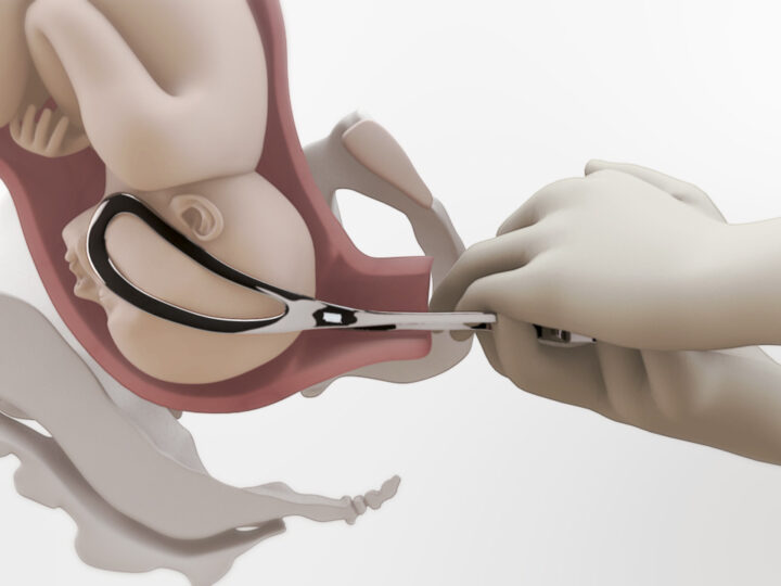 El cirujano-barbero empuña el fórceps